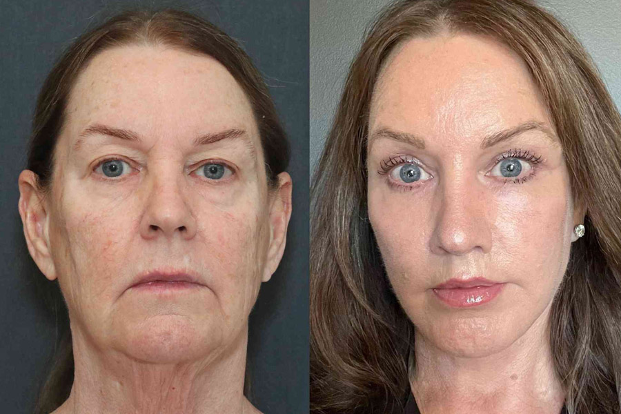 what really happens during a modern facelift it s not what you think