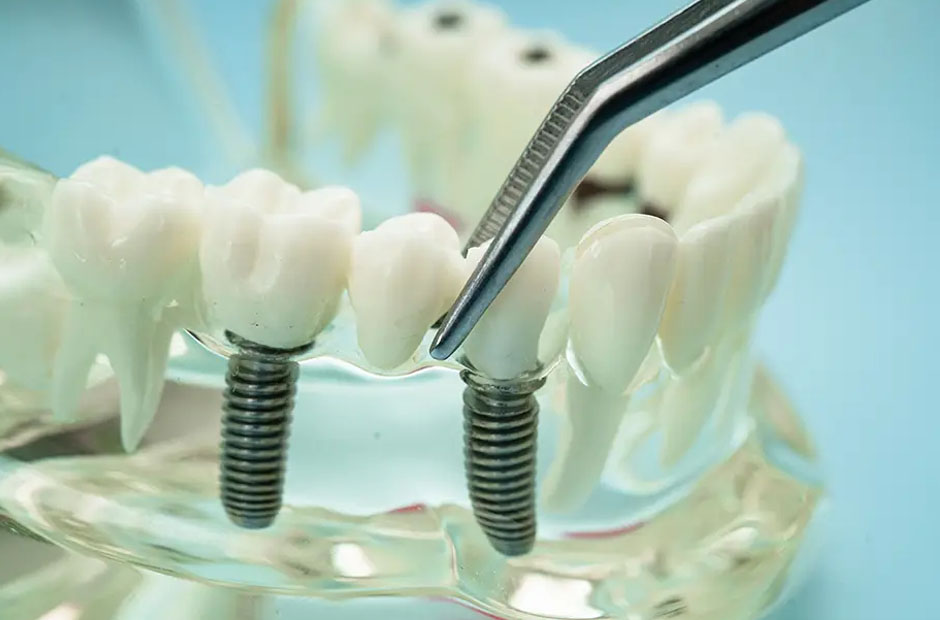 Living Better, Smiling Brighter: The Implant Difference