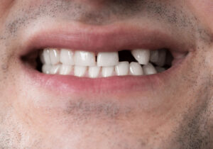 how missing teeth can affect everyday life and your overall well being