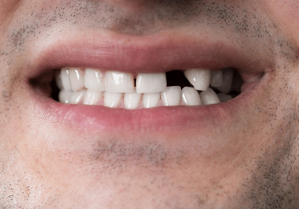 how missing teeth can affect everyday life and your overall well being