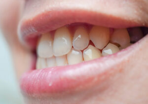 how to tell if you have an impacted tooth key signs and symptoms