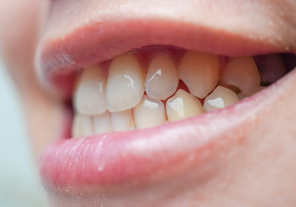 how to tell if you have an impacted tooth key signs and symptoms